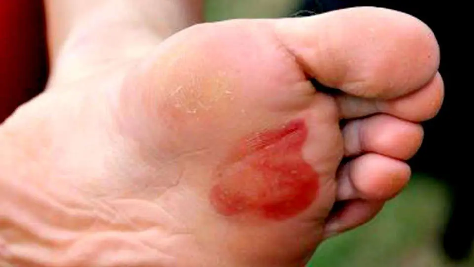 Botines de fútbol y la formación de callos: Causas, prevención y tratamiento - Los jugadores de fútbol tienen callos botines de futbol producen cayos en los piez - Los jugadores de fútbol tienen callos