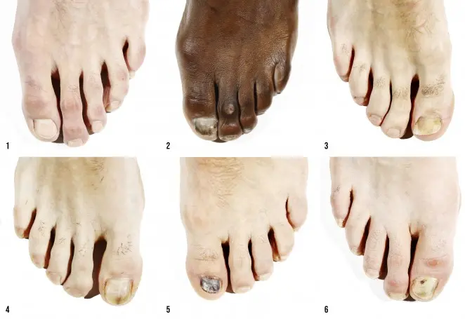 Botines de fútbol y la formación de callos: Causas, prevención y tratamiento - Qué calzado usar para no tener callos botines de futbol producen cayos en los piez - Qué calzado usar para no tener callos