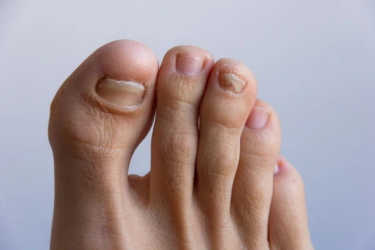 Botines de fútbol y la formación de callos: Causas, prevención y tratamiento - Qué es bueno para que no salgan callos en los pies botines de futbol producen cayos en los piez - Qué es bueno para que no salgan callos en los pies