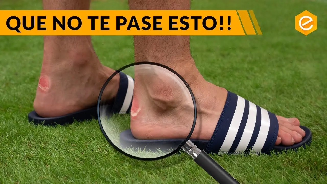 Botines de fútbol y la formación de callos: Causas, prevención y tratamiento - Qué provoca los callos en los pies botines de futbol producen cayos en los piez - Qué provoca los callos en los pies